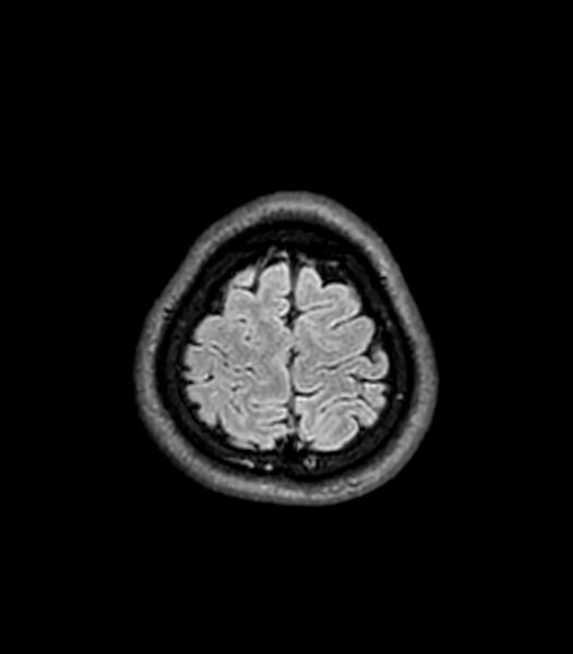 File:Central neurocytoma (Radiopaedia 79320-92380 Axial FLAIR 52).jpg
