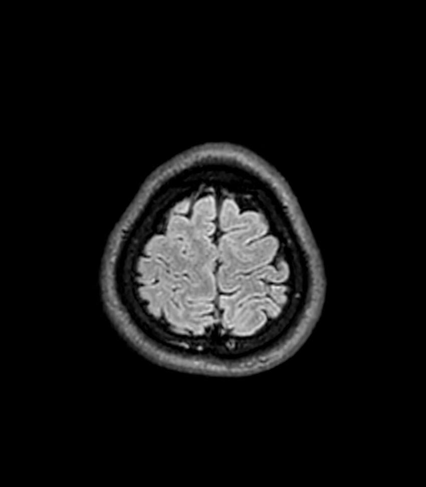 Central neurocytoma (Radiopaedia 79320-92380 Axial FLAIR 52).jpg
