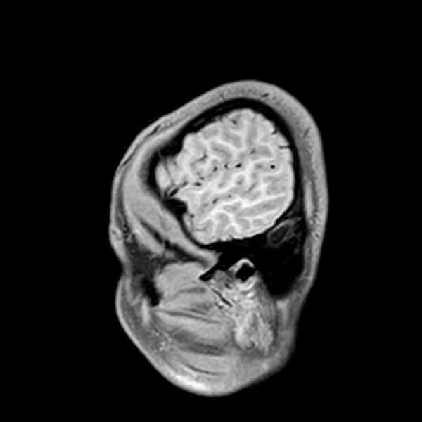 File:Central neurocytoma (Radiopaedia 79320-92380 Sagittal T1 34).jpg