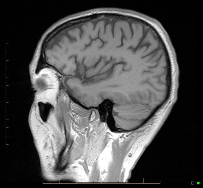 File:Cerebellar gangliocytoma (Radiopaedia 65377-74422 Sagittal T1 34).jpg