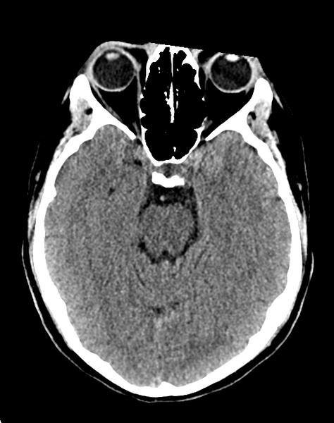File:Cerebellar infarct due to vertebral artery dissection with posterior fossa decompression (Radiopaedia 82779-97033 Axial non-contrast 14).png