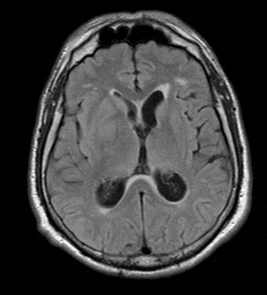 File:Cerebellopontine angle meningioma (Radiopaedia 24459-24764 Axial FLAIR 14).jpg