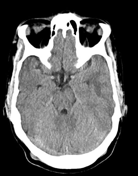 File:Cerebral abscesses (Radiopaedia 70458-80568 Axial non-contrast 24).jpg