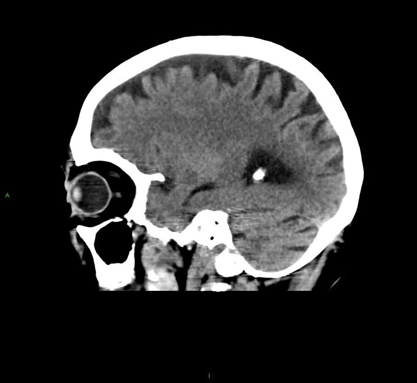 Cerebral amyloid angiopathy-associated lobar intracerebral hemorrhage (Radiopaedia 58376-65511 C 17).jpg