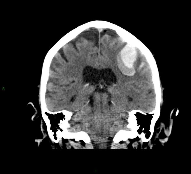 File:Cerebral amyloid angiopathy-associated lobar intracerebral hemorrhage (Radiopaedia 58376-65511 Coronal non-contrast 28).jpg