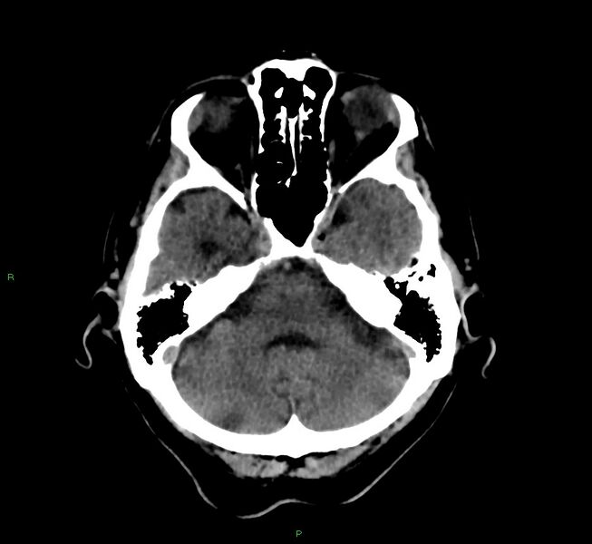 File:Cerebral amyloid angiopathy-associated lobar intracerebral hemorrhage (Radiopaedia 58376-65513 Axial non-contrast 39).jpg