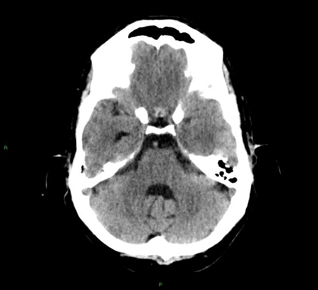 File:Cerebral amyloid angiopathy-associated lobar intracerebral hemorrhage (Radiopaedia 58529-65687 Axial non-contrast 37).jpg