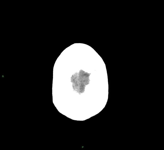 File:Cerebral amyloid angiopathy-associated lobar intracerebral hemorrhage (Radiopaedia 58530-65688 Axial non-contrast 5).jpg