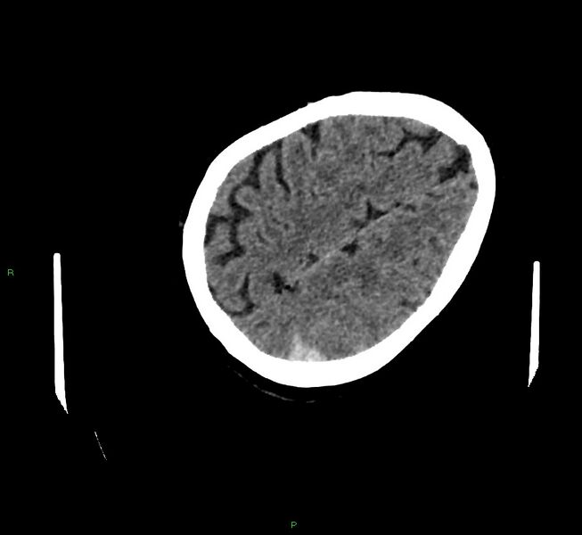 File:Cerebral amyloid angiopathy-associated lobar intracerebral hemorrhage (Radiopaedia 58757-65979 Axial non-contrast 111).jpg