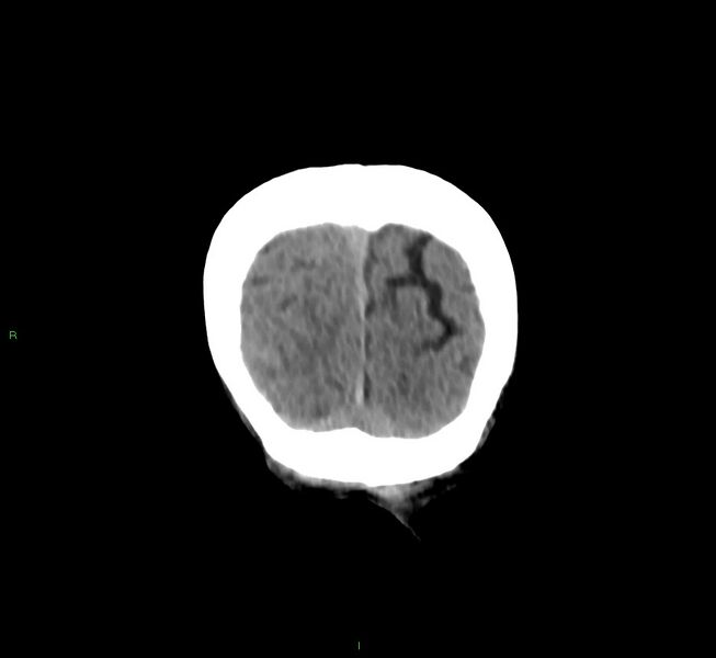 File:Cerebral amyloid angiopathy-associated lobar intracerebral hemorrhage (Radiopaedia 58758-65980 Coronal non-contrast 9).jpg
