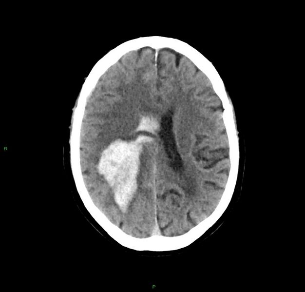 File:Cerebral amyloid angiopathy-associated lobar intracerebral hemorrhage (Radiopaedia 59356-66716 Axial non-contrast 19).jpg