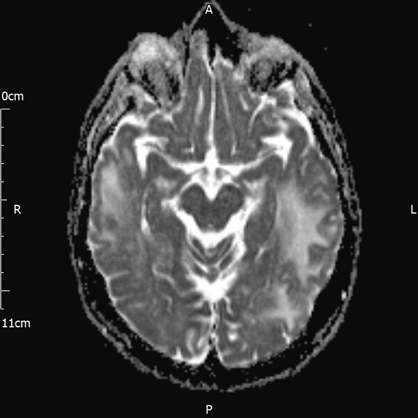 File:Cerebral amyloid angiopathy related inflammation (Radiopaedia 72772-83415 Axial ADC 10).jpg