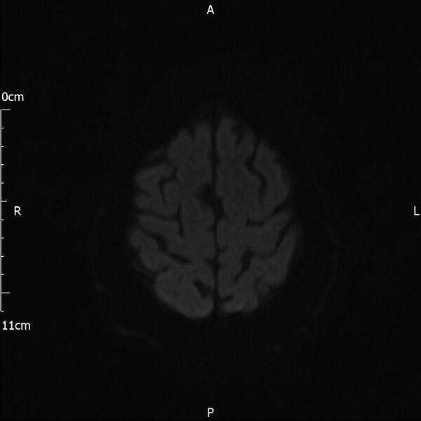 File:Cerebral amyloid angiopathy related inflammation (Radiopaedia 72772-83415 Axial DWI 66).jpg