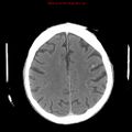 Cerebral and orbital tuberculomas (Radiopaedia 13308-13310 B 21).jpg