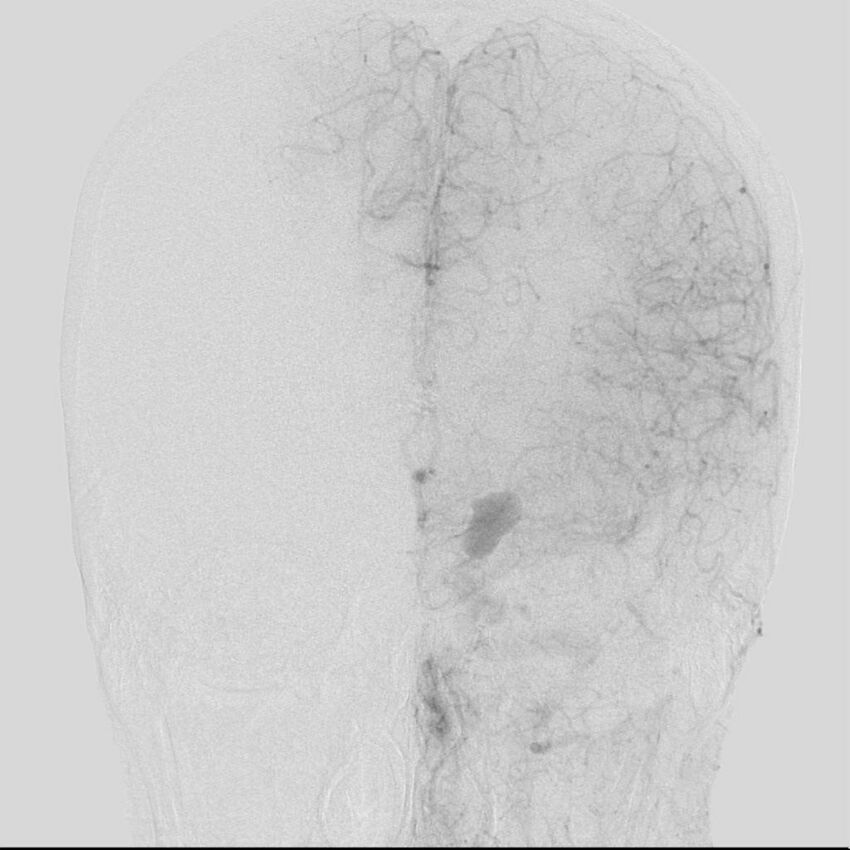 Cerebral aneurysm with rupture (Radiopaedia 29933-30458 LT CCA IC 18).jpg