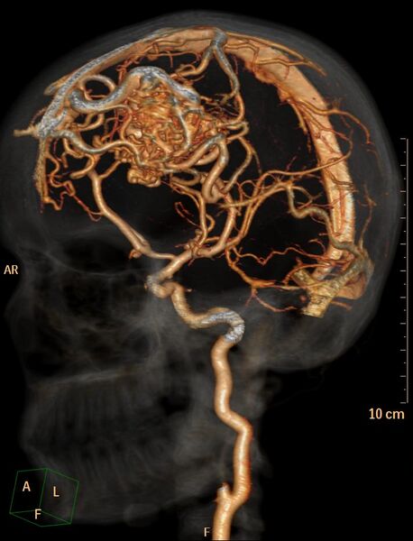 File:Cerebral arteriovenous malformation (Radiopaedia 29531-30031 C 5).jpg