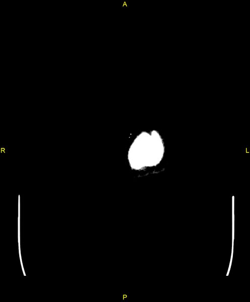 File:Cerebral autosomal dominant arteriopathy with subcortical infarcts and leukoencephalopathy (CADASIL) (Radiopaedia 86108-102051 Axial non-contrast 122).jpg