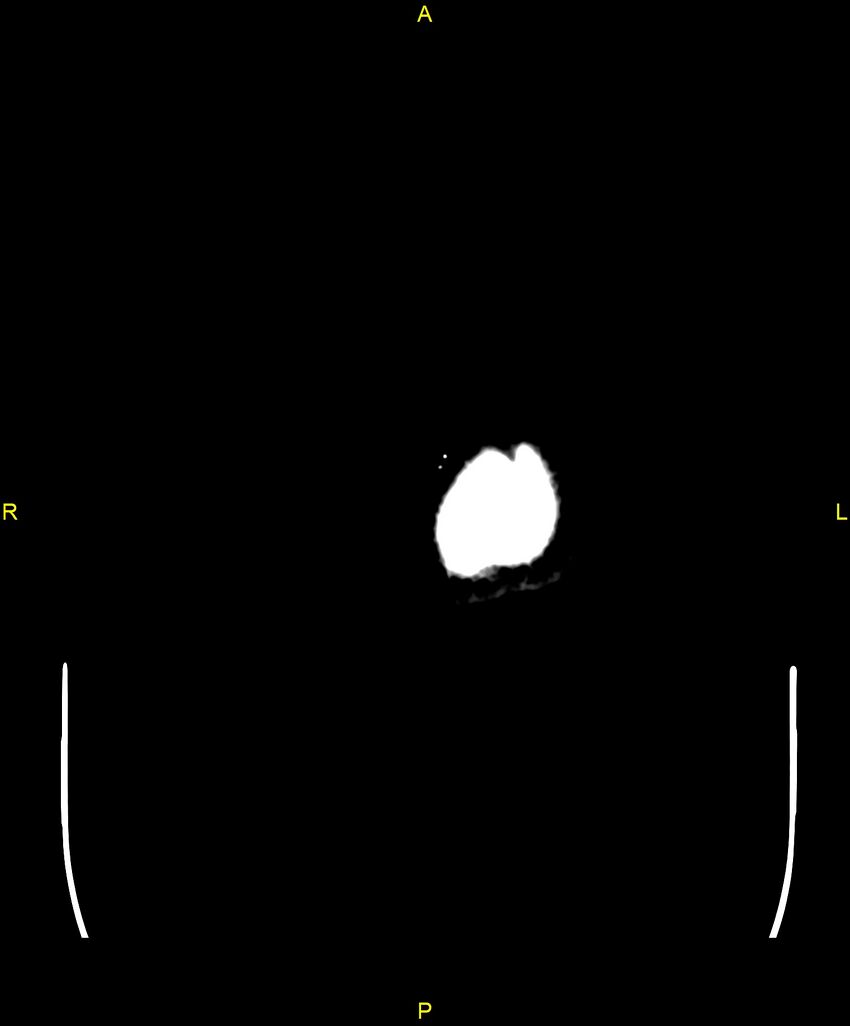 Cerebral autosomal dominant arteriopathy with subcortical infarcts and leukoencephalopathy (CADASIL) (Radiopaedia 86108-102051 Axial non-contrast 122).jpg