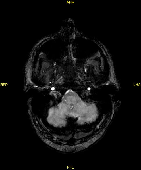 File:Cerebral autosomal dominant arteriopathy with subcortical infarcts and leukoencephalopathy (CADASIL) (Radiopaedia 86108-102054 Axial SWI 17).jpg