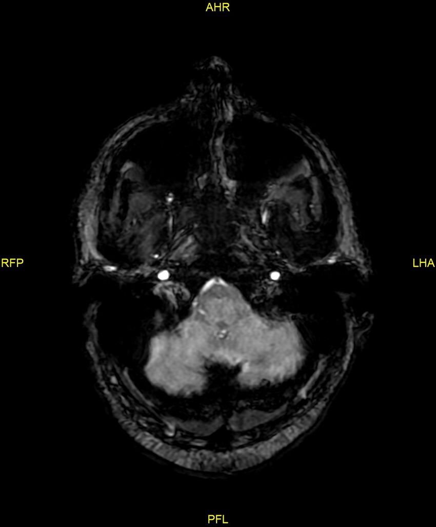 Cerebral autosomal dominant arteriopathy with subcortical infarcts and leukoencephalopathy (CADASIL) (Radiopaedia 86108-102054 Axial SWI 17).jpg