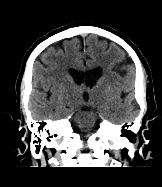 File:Cerebral dural venous sinus thrombosis (Radiopaedia 86514-102575 Coronal non-contrast 24).jpg