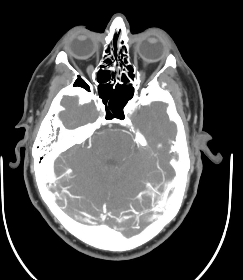 Cerebral dural venous sinus thrombosis (Radiopaedia 86514-102576 A 41).jpg