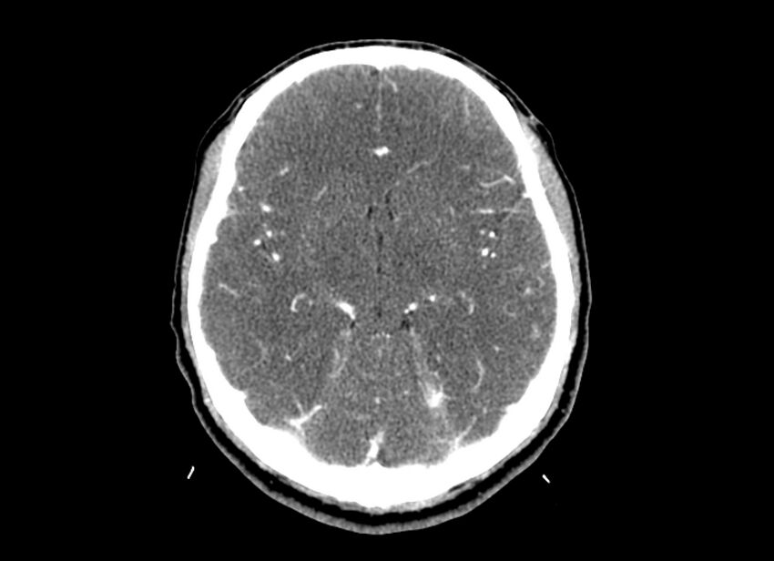 Cerebral edema (Radiopaedia 82519-96661 B 33).jpg
