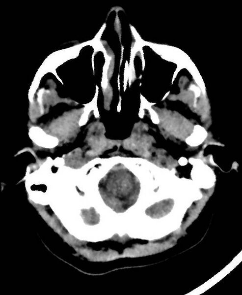 File:Cerebral edema due to severe hyponatremia (Radiopaedia 89826-106937 Axial non-contrast 9).jpg