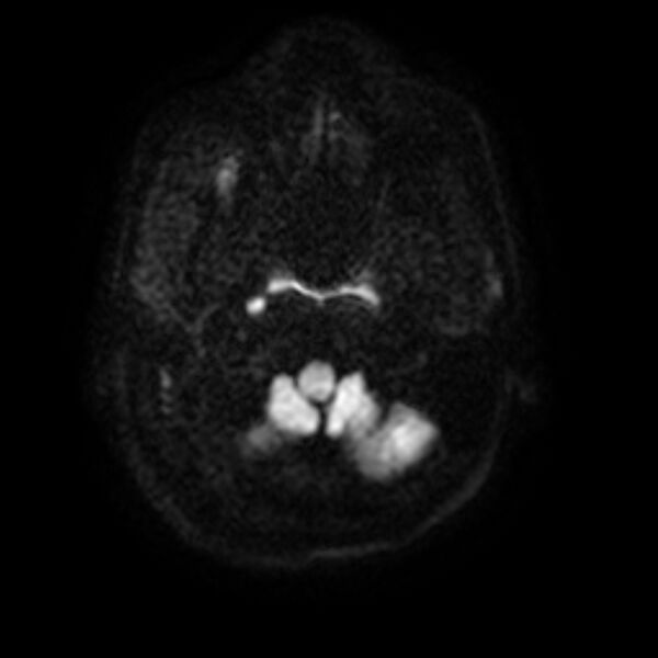File:Cerebral fat embolism (Radiopaedia 37510-39363 Axial DWI 4).jpg