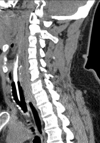 File:Cerebral hemorrhagic contusions and cervical spine fractures (Radiopaedia 32865-33841 G 52).jpg