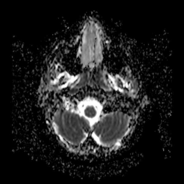 File:Cerebral tuberculoma (Radiopaedia 41152-43932 Axial ADC 2).jpg