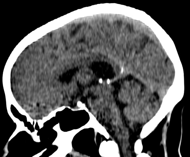 File:Cerebral venous thrombosis - CT only (Radiopaedia 41031-43778 B 17).jpg