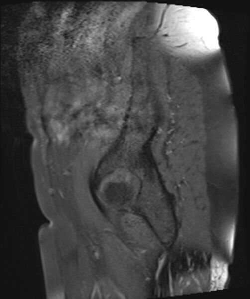 File:Cervical carcinoma (Radiopaedia 88312-104943 Sagittal T1 fat sat 4).jpg