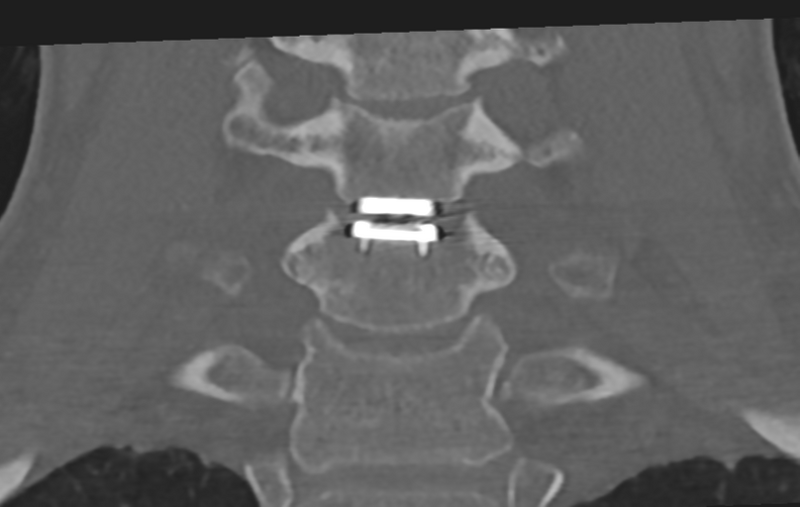 File:Cervical disc replacement (Radiopaedia 37383-39205 Coronal bone window 35).png