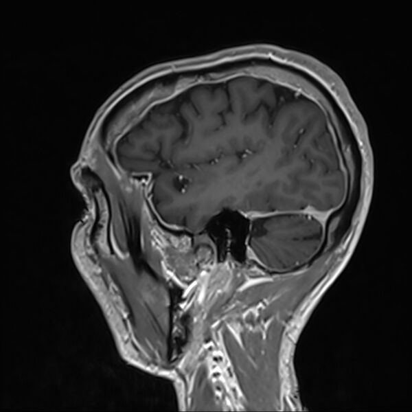 File:Cervical dural CSF leak on MRI and CT treated by blood patch (Radiopaedia 49748-54995 G 100).jpg