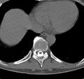 Cervical dural CSF leak on MRI and CT treated by blood patch (Radiopaedia 49748-54996 B 72).png