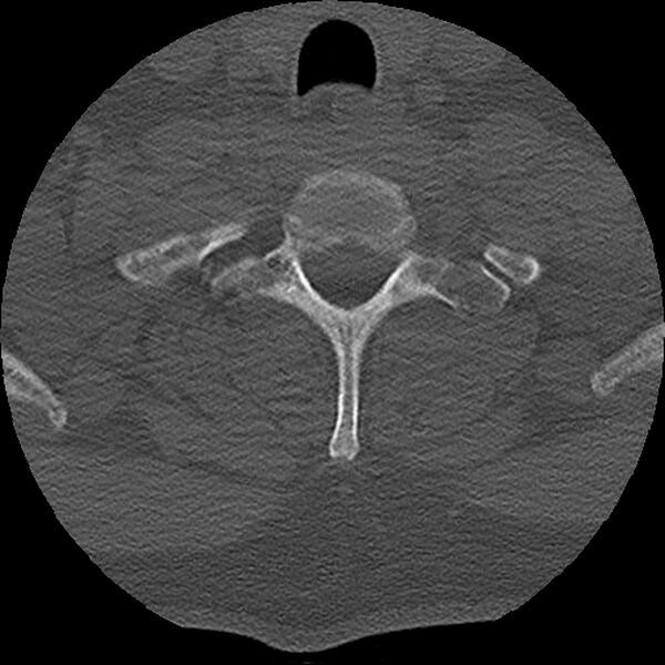 File:Cervical fracture and dislocation with locked facet (Radiopaedia 31837-32780 Axial bone window 22).jpg