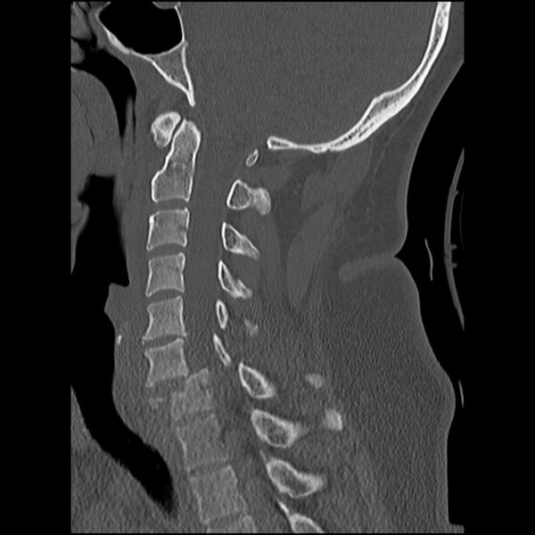 File:Cervical fracture and dislocation with locked facet (Radiopaedia 31837-32780 Sagittal bone window 15).jpg
