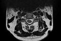 Cervical schwannoma (Radiopaedia 72399-82934 Axial T2 4).jpg