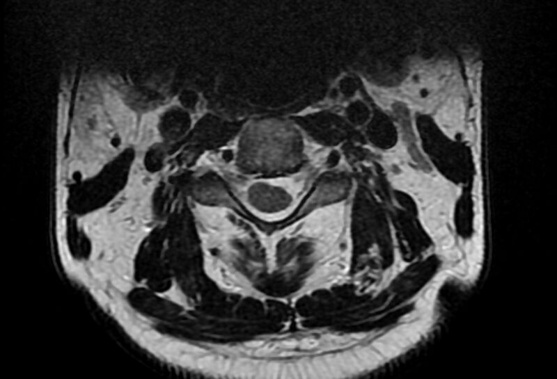 File:Cervical schwannoma (Radiopaedia 72399-82934 Axial T2 4).jpg