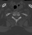 Cervical spine ACDF loosening (Radiopaedia 48998-54070 Axial bone window 51).png