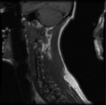 Cervical vertebrae metastasis (Radiopaedia 78814-91667 Sagittal T1 11).png