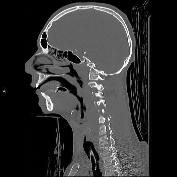 File:Cervical vertebral burst fracture (Radiopaedia 37420-39258 Sagittal bone window 21).jpg
