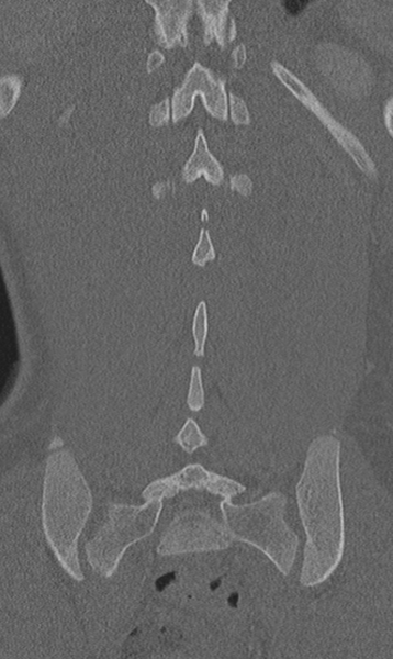 File:Chance fracture (Radiopaedia 40360-42912 Coronal bone window 55).png