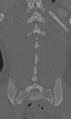 Chance fracture (Radiopaedia 40360-42912 Coronal bone window 55).png