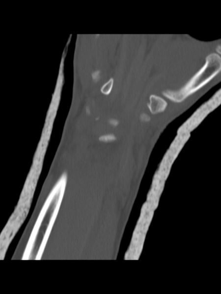 File:Chauffeur's (Hutchinson) fracture (Radiopaedia 58043-65079 Coronal bone window 1).jpg