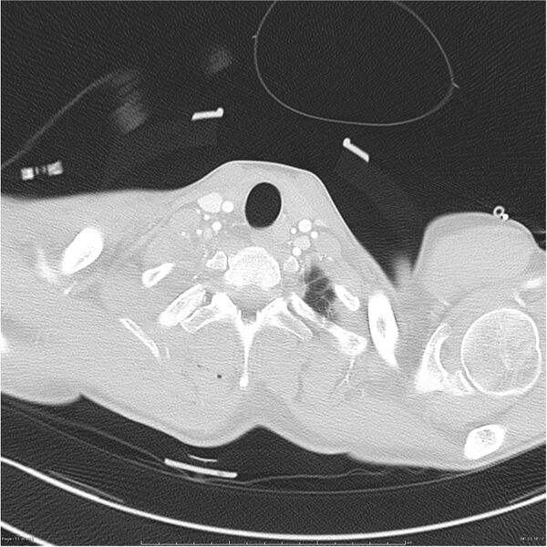 File:Chest and abdomen multi-trauma (Radiopaedia 26294-26425 lung window 11).jpg