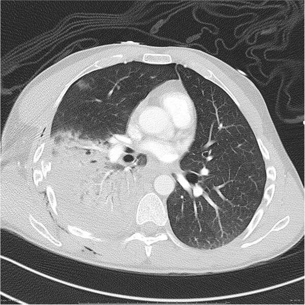 File:Chest and abdomen multi-trauma (Radiopaedia 26294-26425 lung window 56).jpg