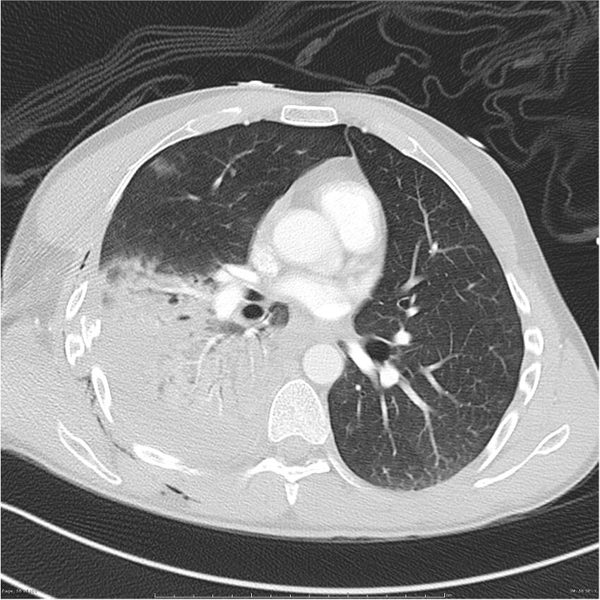 Chest and abdomen multi-trauma (Radiopaedia 26294-26425 lung window 56).jpg
