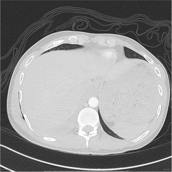File:Chest and abdomen multi-trauma (Radiopaedia 26294-26425 lung window 89).jpg
